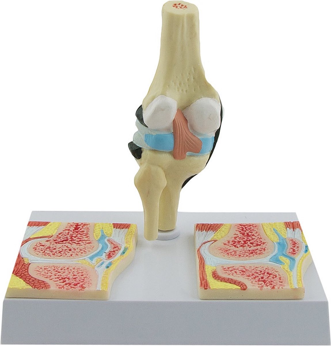 Het menselijk lichaam - anatomie model knie met reuma
