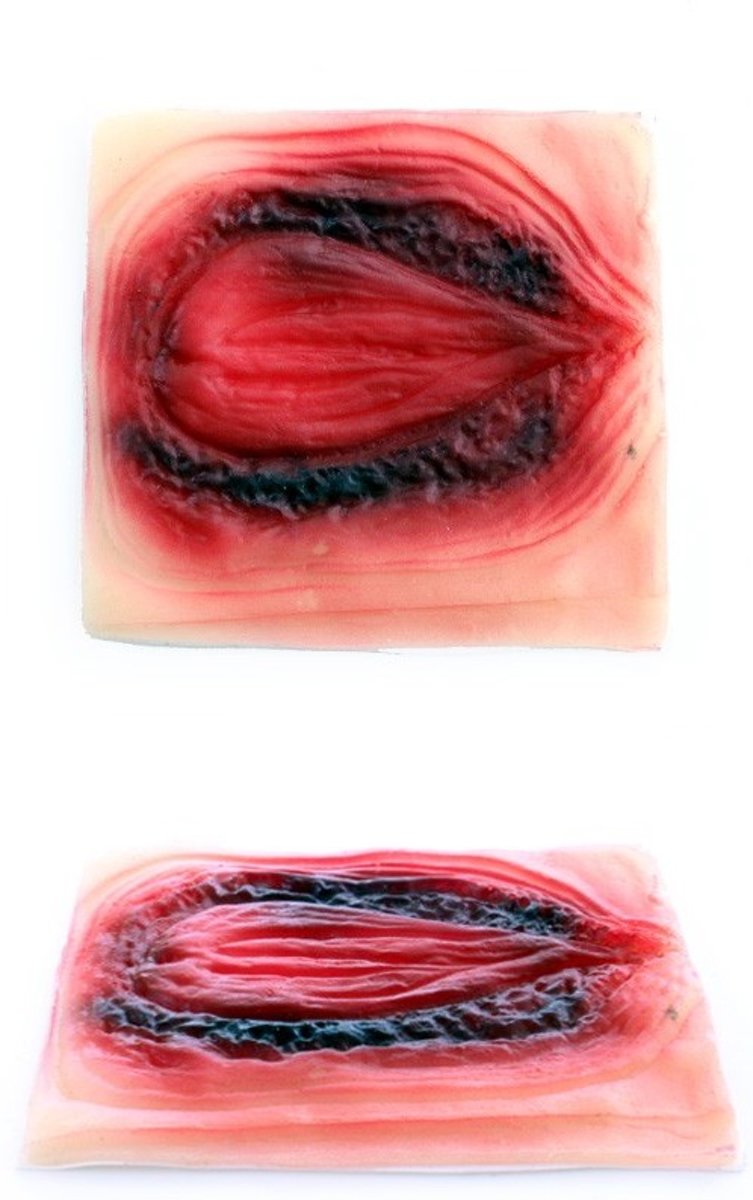 Litteken brandwond groot